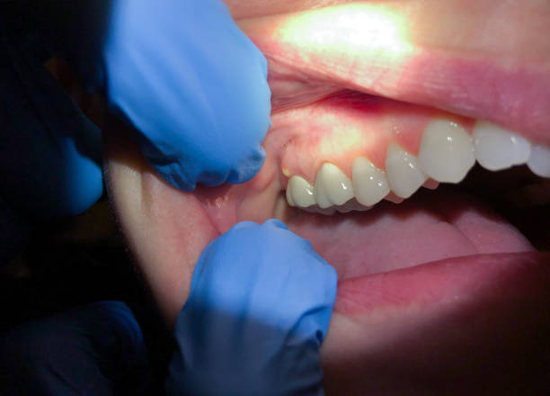 Best Emergency Treatment for Dental Infections or Abscesses in Sharon Center, OH